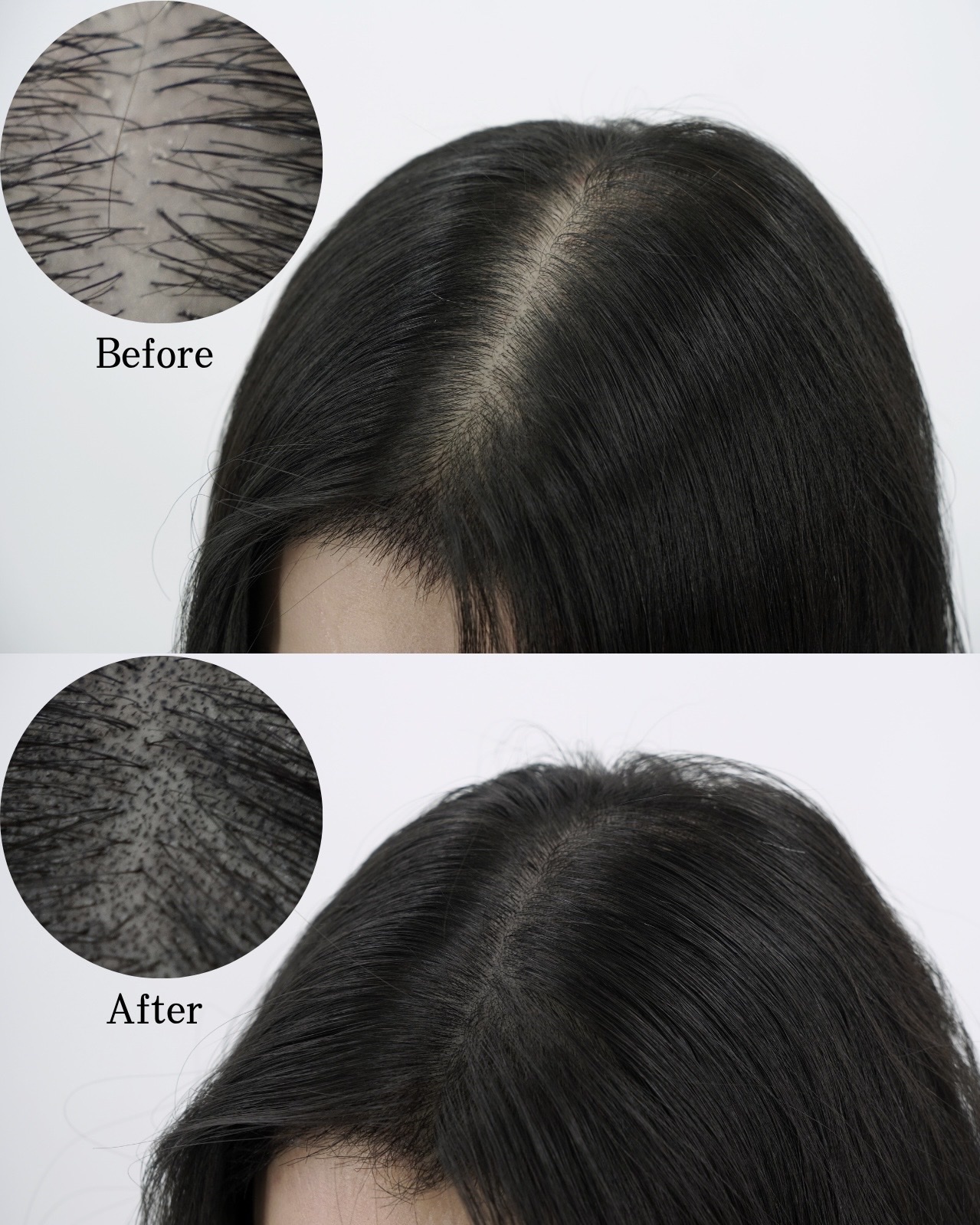 SMP before and after result for hair parting density