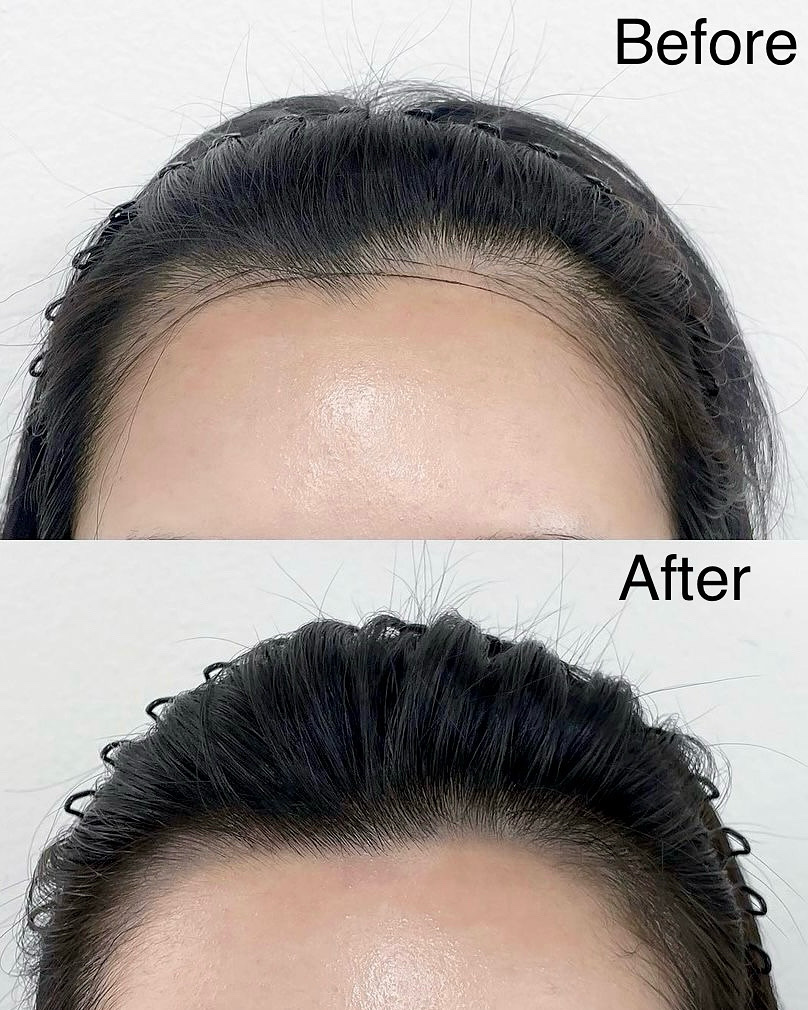 SMP before and after result for hairline density