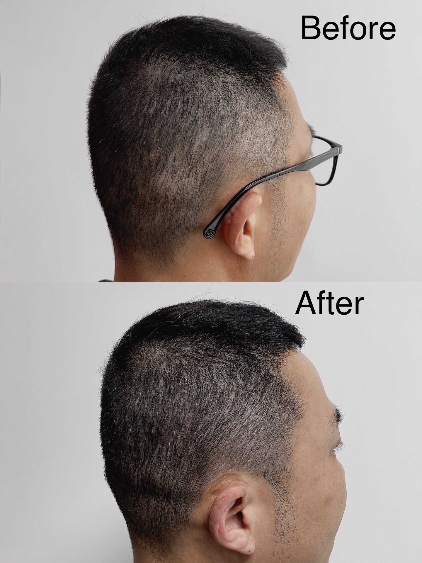 SMP before and after result for hair donor area