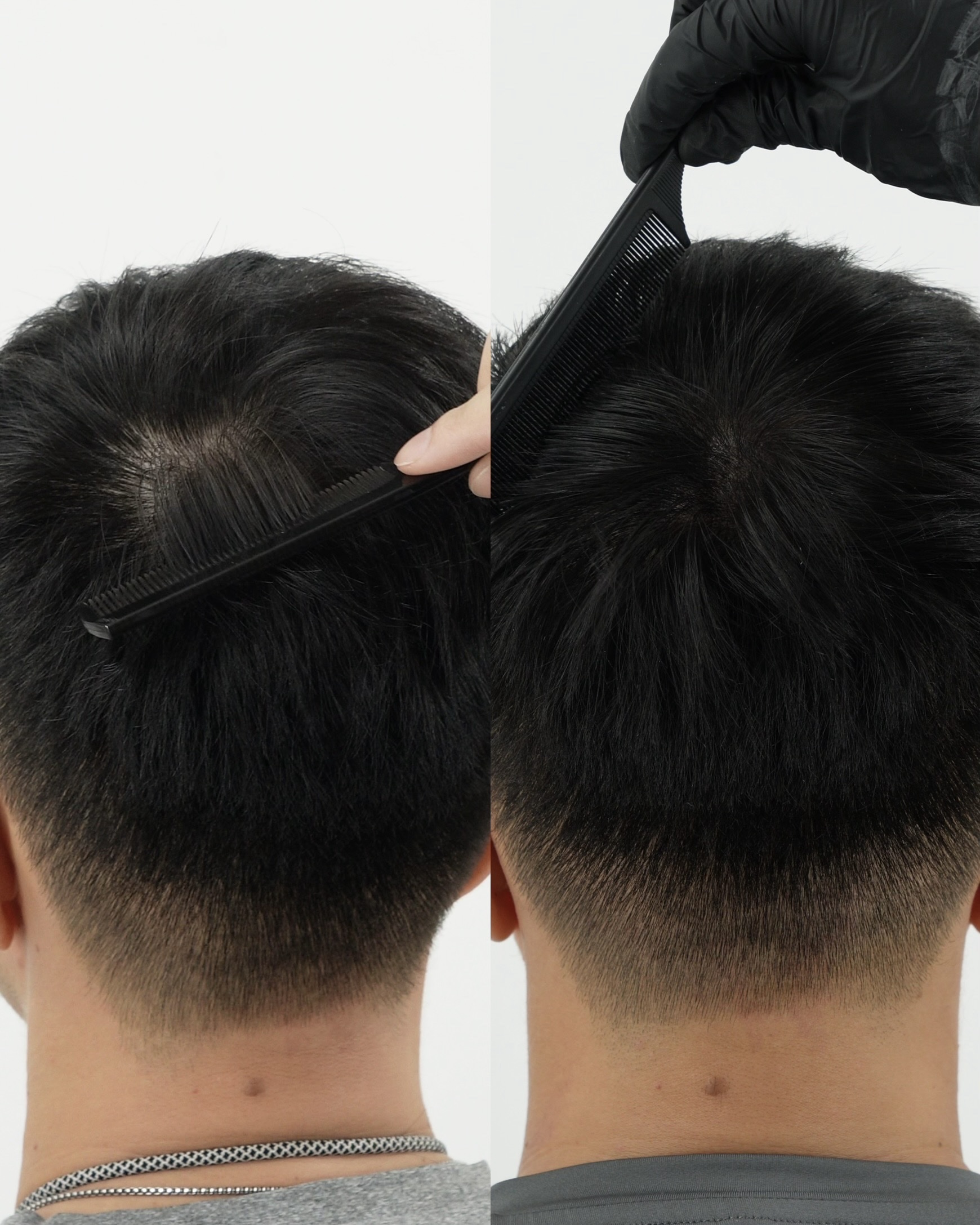 SMP before and after result for crown coverage