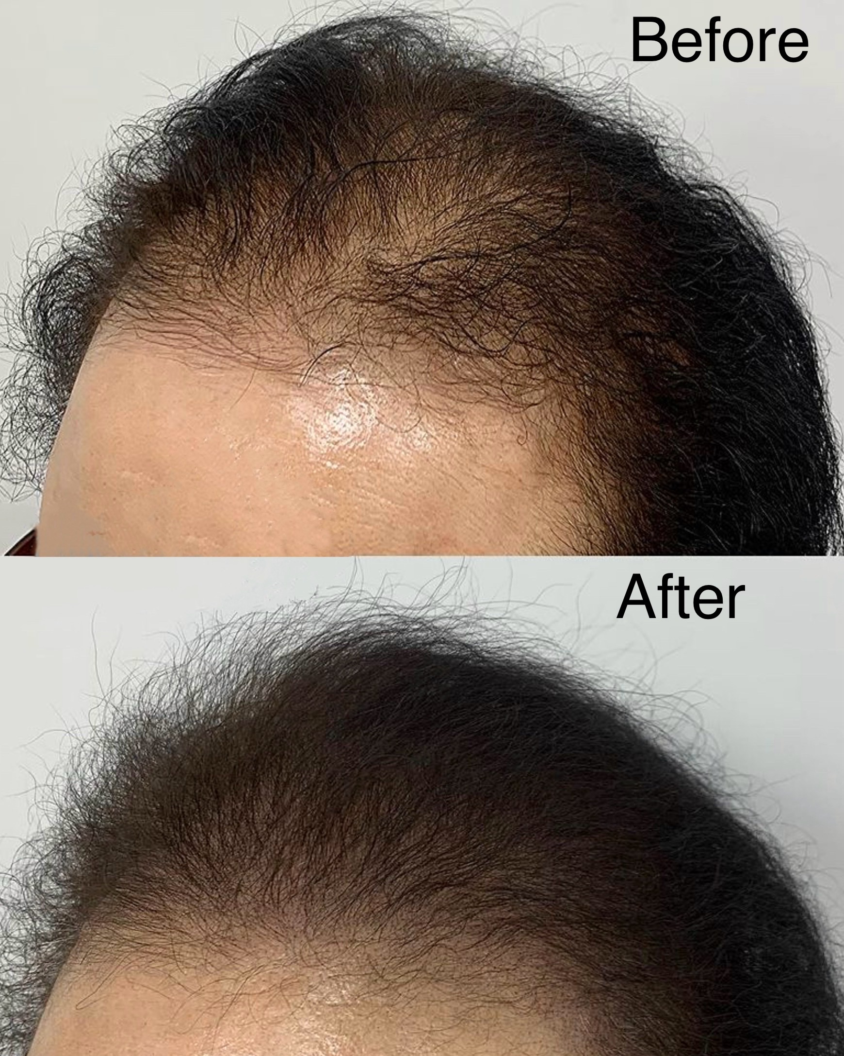 SMP before and after result for crown density